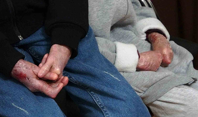 Memurun yazışma hatası nedeniyle 20 kelebek hastasının boğaz ameliyatı ertelendi