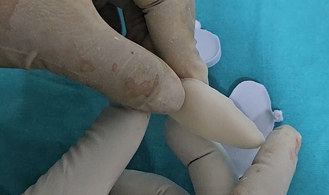 İlk kez 3D yazıcı tekniğiyle kafatası ameliyatı