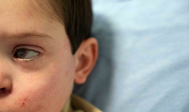 Yüzünün sol tarafı felç olan 4 yaşındaki Burak’a ’akupunktur’ tedavisi umut oldu