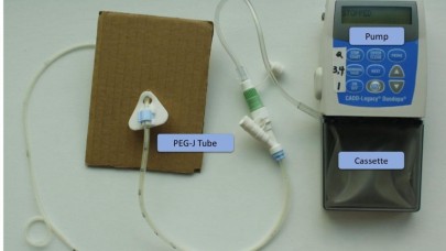 Günde kullandığı 12 ilaçtan tek tedaviyle kurtuldu