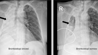 5 Ay Boyunca Nefes Alamadı! Sebebi Doktorları Şoke Etti