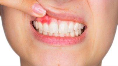Diş eti problemlerine dikkat, uzmanlar uyarıyor: "Sessiz ilerler"