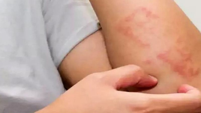 Bu iki kavramı karıştırmayın, besin alerjisi mi besin intoleransı mı