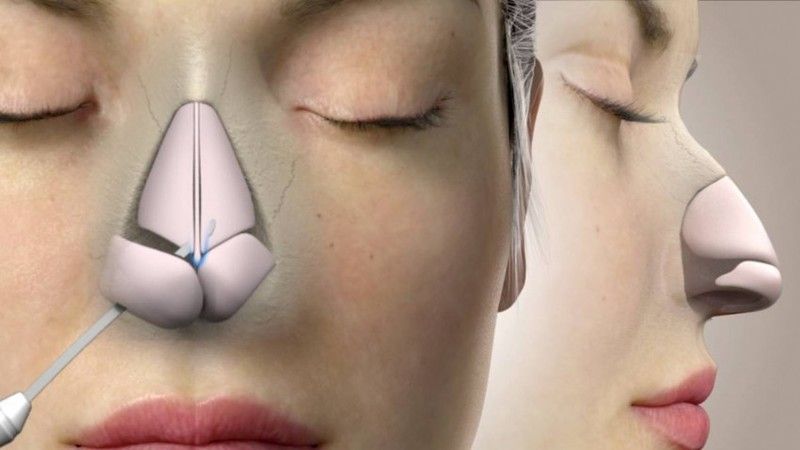 Burun estetiğinde son trend: Tamponsuz yöntem