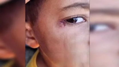 Şanlıurfa’da bir öğrencinin gözünde sigara söndürüldü iddiası