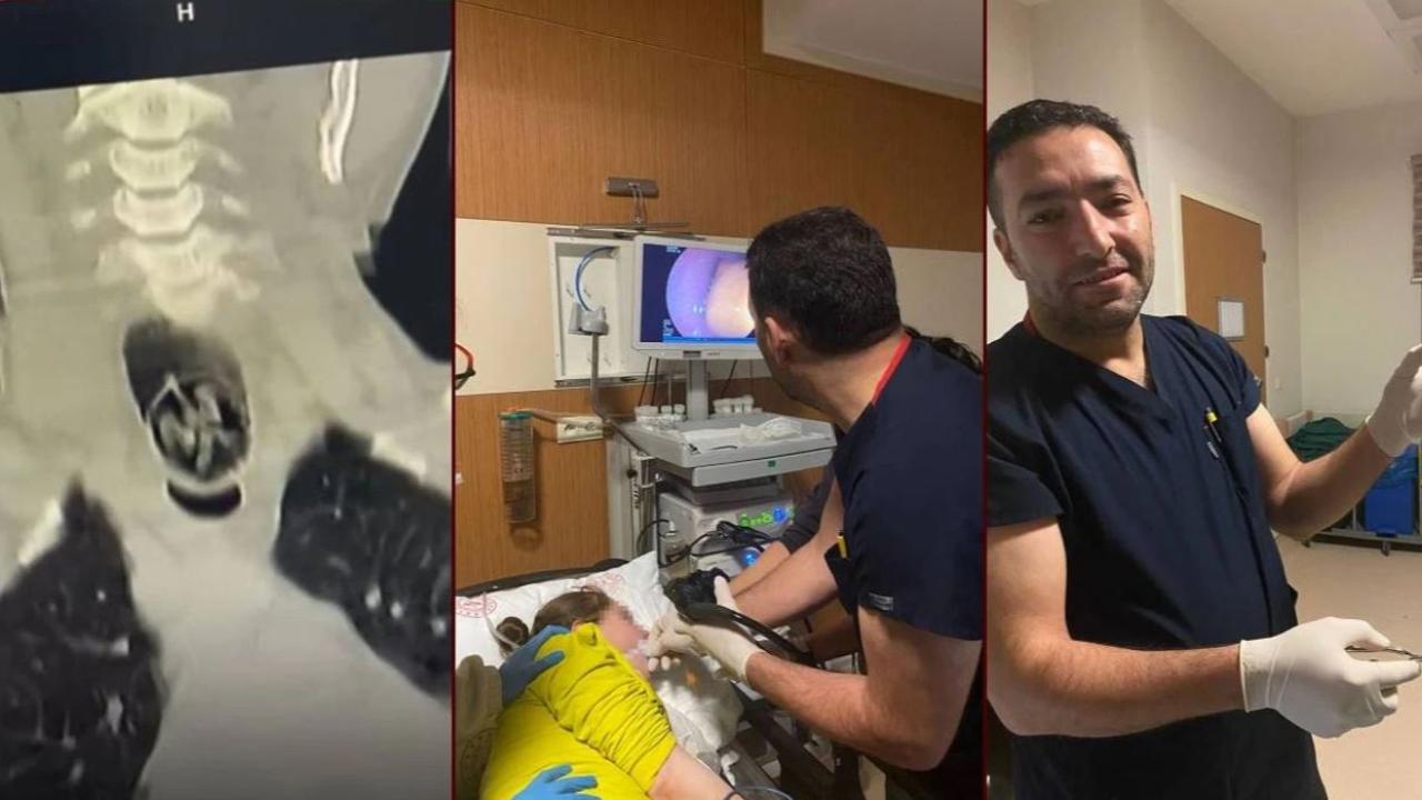 Yuttuğu ceviz yemek borusundan çıkarıldı