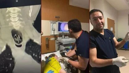 Yuttuğu ceviz yemek borusundan çıkarıldı