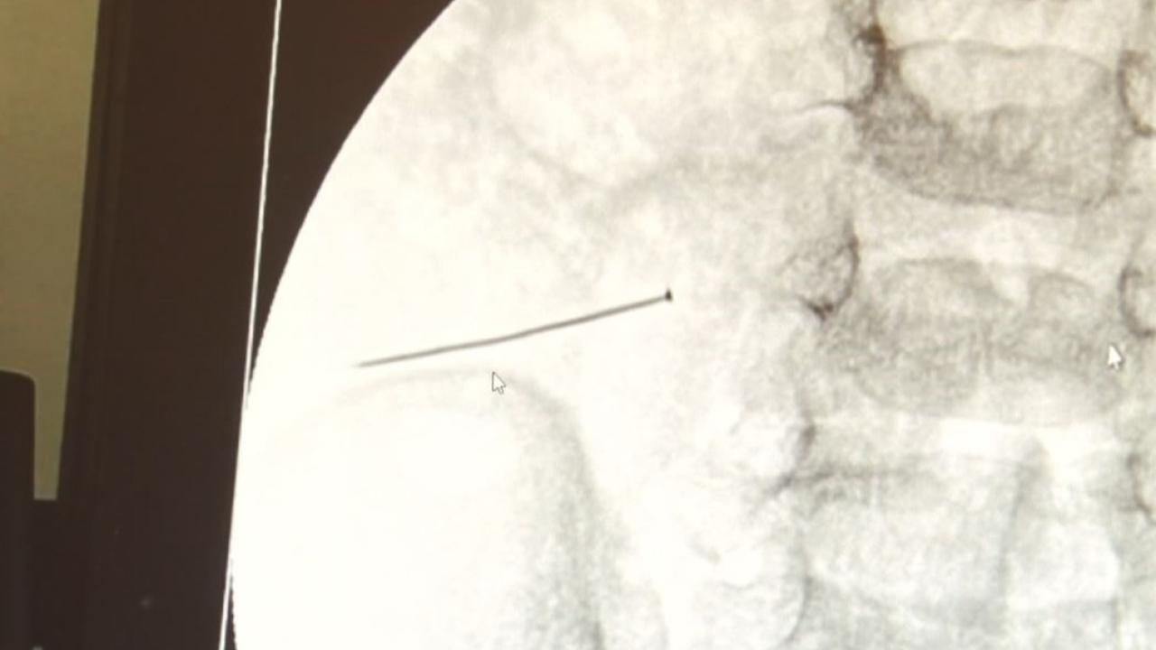 Ağrıyla kıvranan 2 yaşındaki çocuğun bağırsağından 3 santimlik iğne çıktı