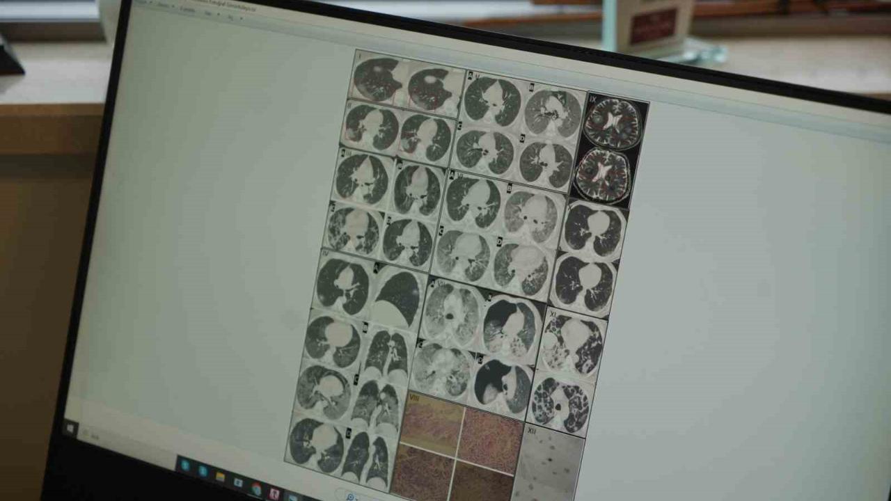 Gençlerde ani ölümler artıyor: &quot;Nedeni ise virüsün damarlarda bıraktığı hasar&quot;