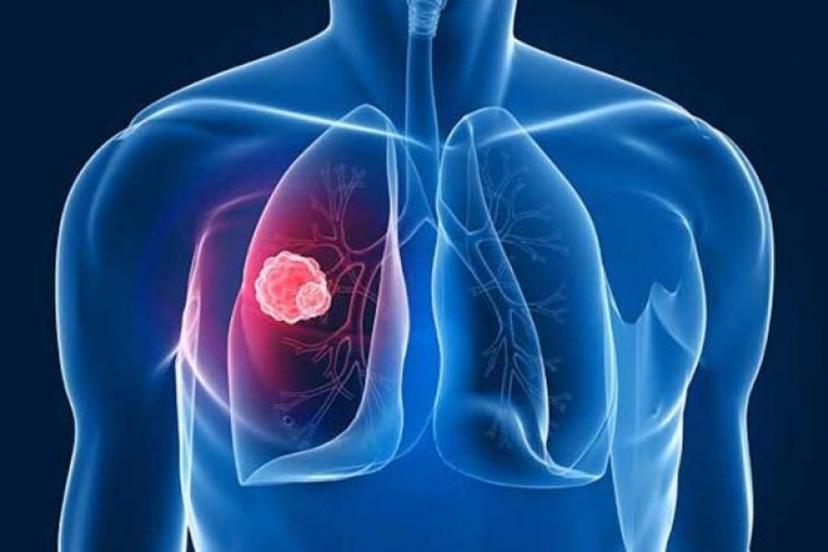 Şanlıurfa kanser ölümlerinin en az görüldüğü iller arasında!