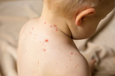 Suçiçeğine dikkat : "İlk defa böyle bir sıklık görüyoruz"